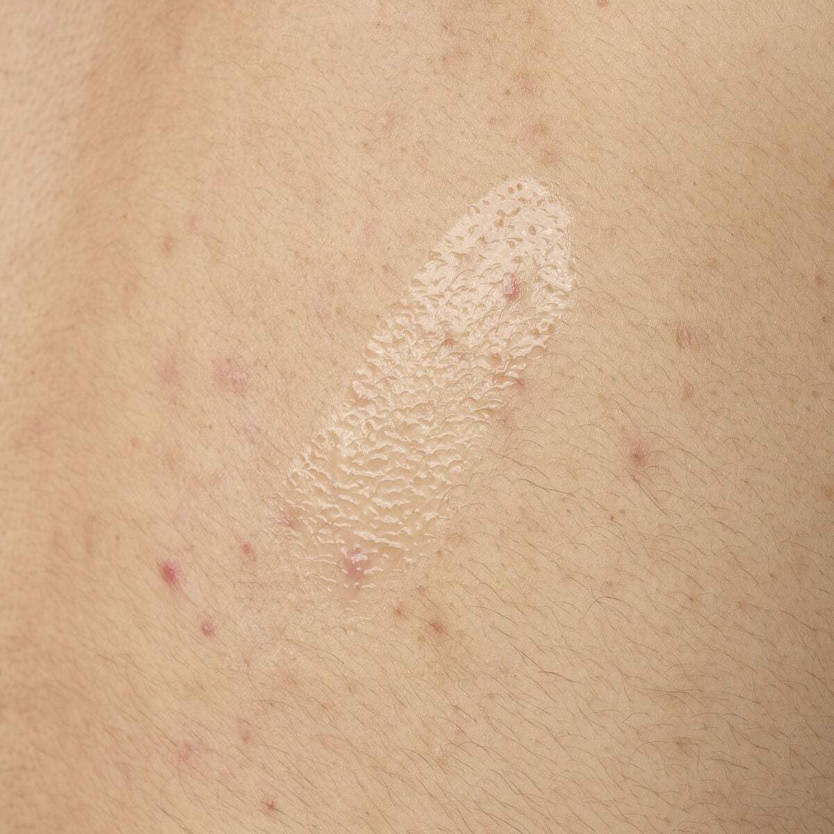 salicylic-acid-0-5-body-serum-e3 ORD-salicylic-acid-05-body-240ml-application.jpg