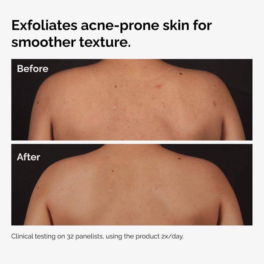 the-body-care-collection-q3 ord-salicylic-acid-body-serum-before-after-graphic-NA.jpg