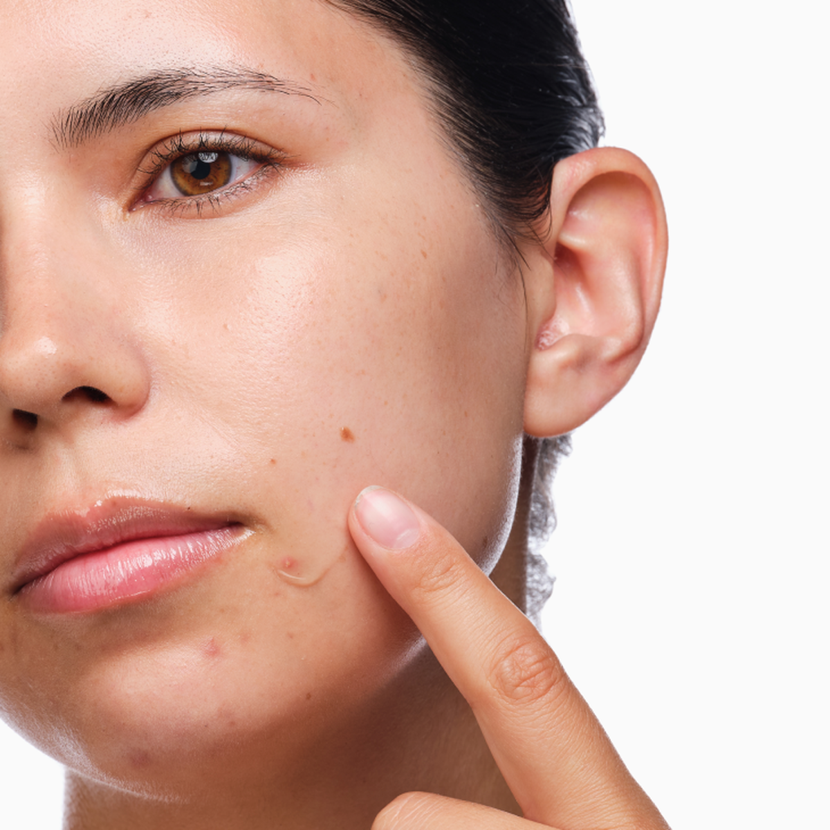 the-acne-set-z8 rdn-the-acne-set-application.png